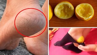 Get Rid of Dry Cracked Feet and Calluses Using Lemon Peel