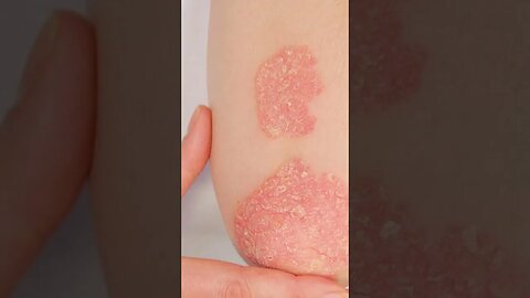 How to Prevent and Treat the Rash Caused by Keto
