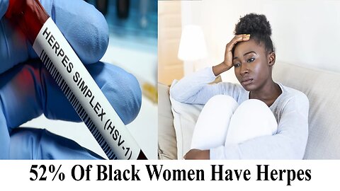 52% Of Black Women Have Genital Herpes! What Does This Say About Them To You?