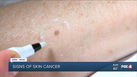 Your Healthy Family: Signs of skin cancer
