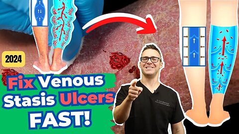Venous Stasis Dermatitis, Varicose Veins & Venous Ulcers! [Treatment]