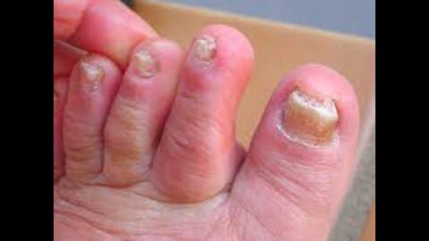 Toe Nail Infection Explained