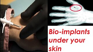 Bio-implants under your skin