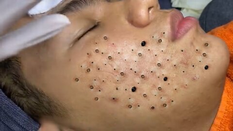 Blackheads Blackhead Removal Acne Extraction Relaxing #82