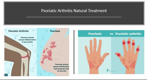 Psoriatic Arthritis Natural Treatment