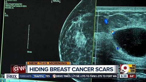 Local doctor performs 'hidden scar' surgery on breast tumors
