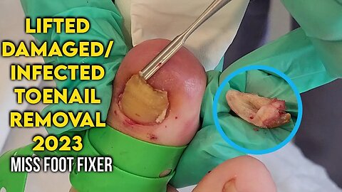 LIFTED DAMAGED/INFECTED TOENAIL REMOVAL 2023 BY FEET DOCTOR MISS FOOT FIXER
