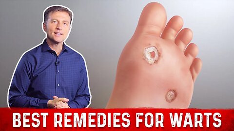 4 Best Wart Removal Remedies – Dr. Berg on Wart Treatment at Home