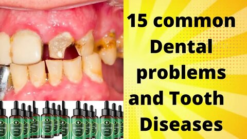 Dental Care :15 Common Dental Problems and Tooth Diseases