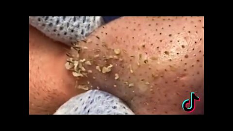 CRAZY BLACKHEAD EXTRACTIONS Compilation