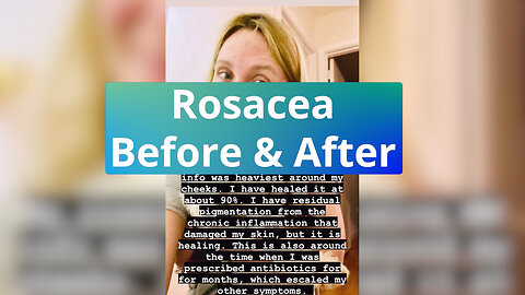 Rosacea Before & After - Repost from @heal_infertility