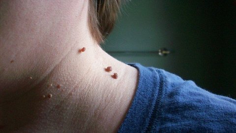 Skin Tags: What They Are and How to Get Rid of Them