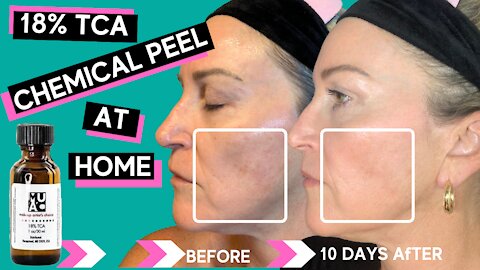 TCA CHEMICAL PEEL BEFORE & AFTER - My Skin Is Peeling Off My Face! #faceburn #chemicalpeel #skincare