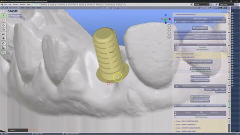 Making an implant crown