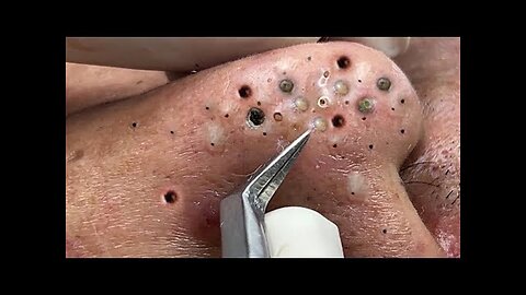 Satisfying Blackheads Cystic Acne Whiteheads Extraction | Dr. Pimple Popper