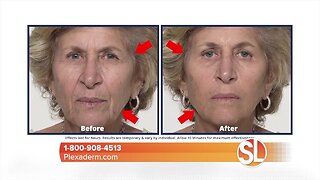 Give you mom the gift of looking younger this Mother's Day with Plexaderm