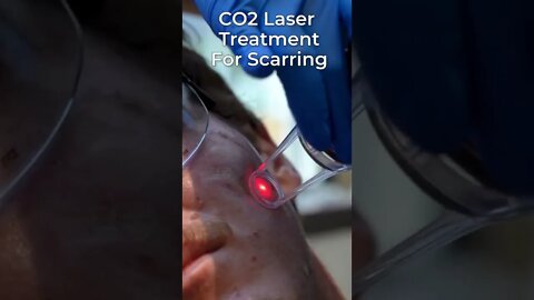 Healing Scars With A Laser! 😯🥽