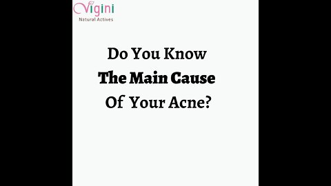 Vigini 15% Actives Anti Acne Face Serum Pimple Scar Blemish Dark Spot Pigmentation Removal Oily Skin
