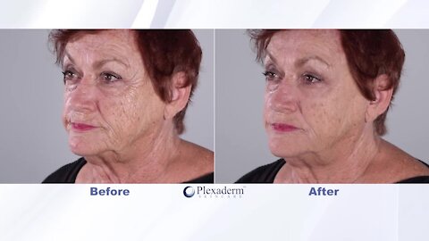 Get rid of under eye bags and wrinkles for up to 10 hours with Plexaderm
