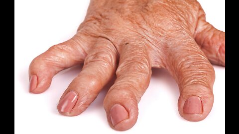 Rheumatoid Arthritis Dr Wallach