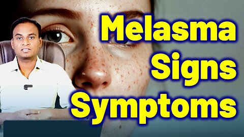 Signs And Symptoms Of Melasma | Melasma Treatment & Cure Melasma Remedy Dr. Bharadwaz | Homeopathy