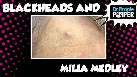 Blackhead and Milia MEDLEY