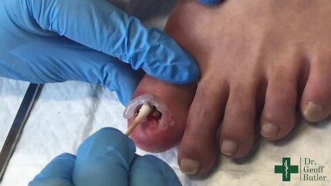 Complete Removal of a Dystrophic nail