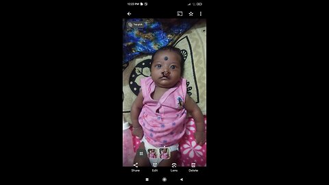 Lilly Grace bilateral cleft before repair