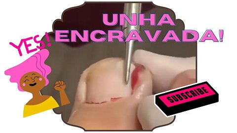 Cuidado! Imagens fortes: remoção de unha encravada #ingrown_toenail #unhaencravada #podologia