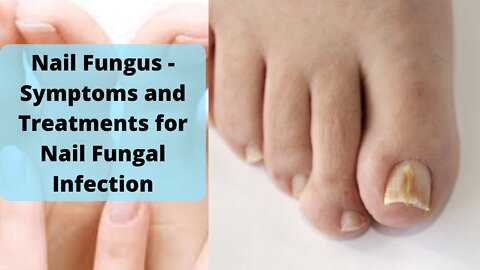 Nail Fungus - Symptoms and Treatments for Nail Fungal Infection