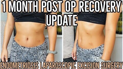 1 MONTH POST OP RECOVERY UPDATE 2021|ENDOMETRIOSIS LAPAROSCOPIC EXCISION SURGERY RECOVERY |ez tingz