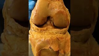 Inside of a Real Human Knee