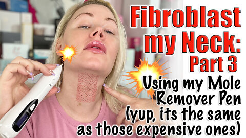 Fibroblast my Neck with Mole Pen : Part 3 with Velatox for healing | Code Jessica10 Saves you Money!