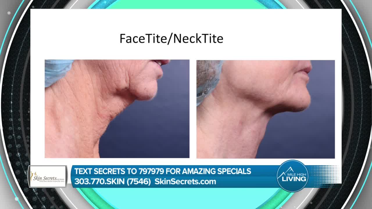 Skin Secrets- Non Surgical Skin Tightening