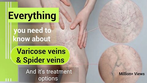 Difference between Varicose veins and spider veins and it's treatment options | Wikiaware