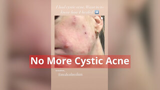 No More Cystic Acne - Repost from @smultron_