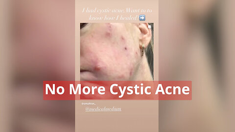 No More Cystic Acne - Repost from @smultron_