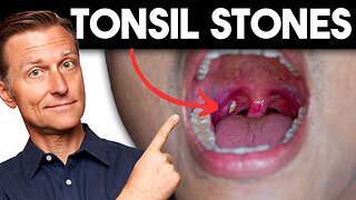 Tonsil Stones: Removing the Deeper Cause