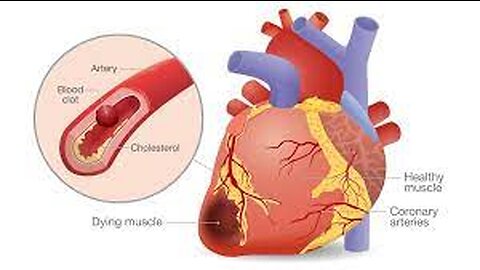 "Under Attack: A Look Inside the Heart During a Heart Attack"