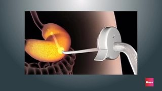 FDA approves weight loss stomach pump | Rare News