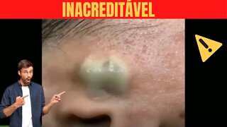 Espremendo CRAVOS GIGANTES - Retirando Cravos e Espinhas Gigantescas Satisfatório Pimples Extraction