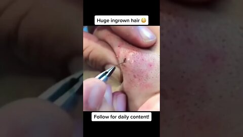 Enormous Ingrown Hair Removal