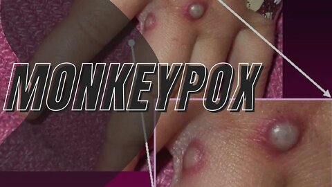 🔴 Rare monkeypox outbreak in U.K., Europe and U.S.: What is it and should we worry?