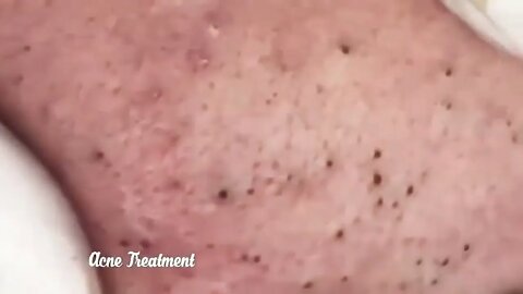Satisfactory Video Blackhead Removal Skin Cleansing #2 | 2022 Video