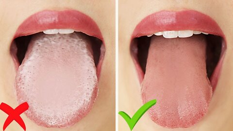 How To: Get Rid of White Tongue & Bad Breath Instantly!