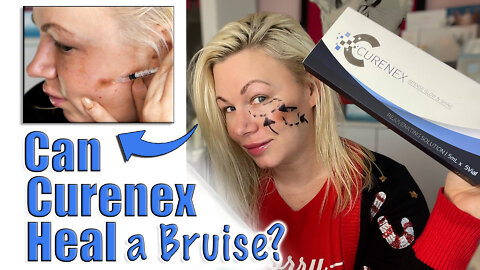 Can Curenex Heal a Bruise? Let's test! www.acecosm.com | Code Jessica10 Saves you Money!