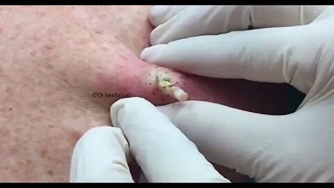 Huge Cyst Removal! Total Satisfaction!! blackhead acne pimple whitehead