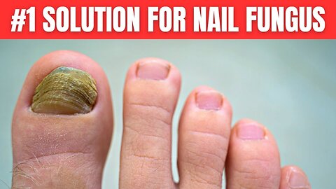 You Need Only 2 Ingredients To Get Rid of Nail Fungus Completely