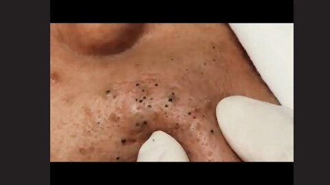 REMOVENDO ESPINHA GIGANTE VIDEOS SATISFATORIOS vídeos relaxantes - huge pimples and blackheads