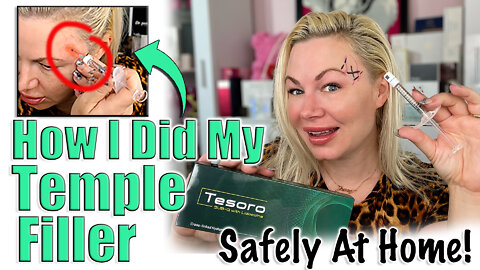 How I did my Temple Filler Safely at Home w/ Tesoro Impant AceCosm | Code Jessica10 Saves you Money!